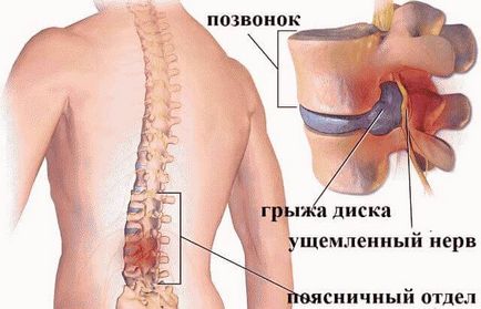 Cum să vindeci o coloană vertebrală lombară fără intervenție chirurgicală