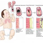 Як вилікувати кашель у дитини що робити, щоб швидко його позбутися