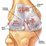 Як я лікувала остеоартроз колінного суглоба щоденники