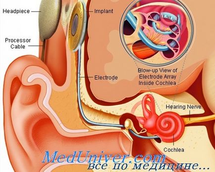 Tratamentul conservativ al zgomotelor urechilor cu otoscleroză