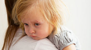 Кір у дітей - симптоми, як виглядає висип на фото