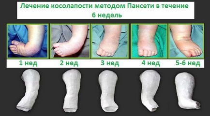 Clubfoot, fotografii înainte și după, intervenții chirurgicale, recenzii, tratament, reabilitare și recuperare