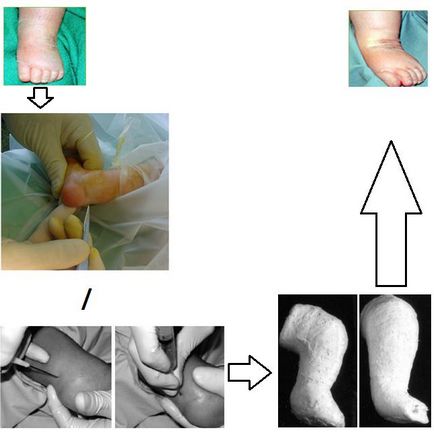 Clubfoot, fotografii înainte și după, intervenții chirurgicale, recenzii, tratament, reabilitare și recuperare