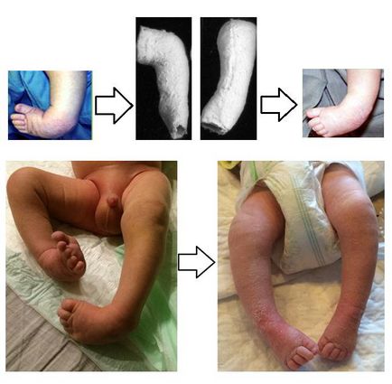 Клишоногість, фото до і після, операція, відгуки, лікування, реабілітація та відновлення