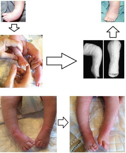 Clubfoot, fotografii înainte și după, intervenții chirurgicale, recenzii, tratament, reabilitare și recuperare