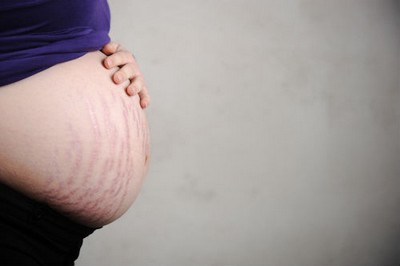 Krém terhességi csíkok sanosan