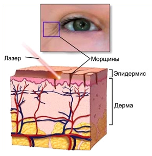 Tratamentul cu laser fracțional