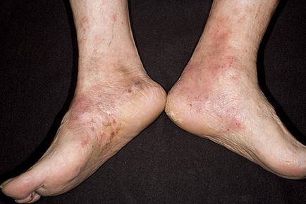 Tratamentul eczemei ​​ude pe diferite părți ale corpului (cap, brațe, picioare)