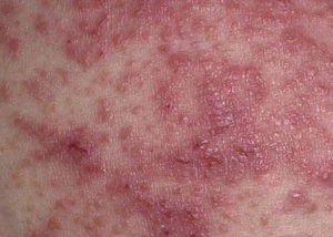 Tratamentul eczemei ​​ude pe diferite părți ale corpului (cap, brațe, picioare)