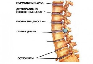 Лікування поперекового остеохондрозу довгий і трудомісткий процес