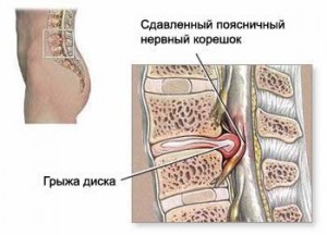 Tratamentul osteocondrozei lombare este un proces indelungat si consumator de timp