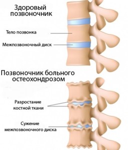 Tratamentul osteocondrozei lombare este un proces indelungat si consumator de timp