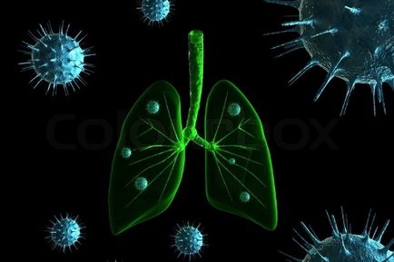 Pneumonie la stânga la adulți și copii simptome, diagnostic, tratament, pneumonie 03