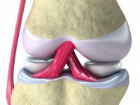 Лігаментит колінного суглоба і власної зв'язки надколінника