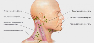 Lymphadenitis leírás, okoz, a tünetek