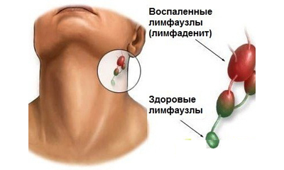 Limfadenită Descriere, cauze, simptome