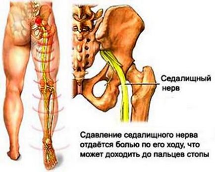 Lumboschialgia - simptomele, tratamentul, nici un accident vascular cerebral! Proiectul este puterea speranței