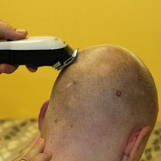 Метод fue - безшовний спосіб пересадки волосся, центр трансплантації і лікування волосся