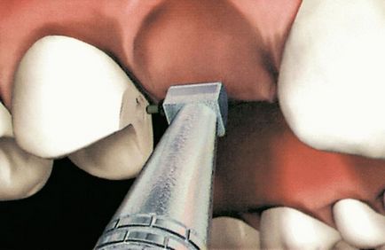 Protetica dentară cu sistemul cbw, costurile și beneficiile sale
