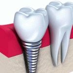 Protetica dentară cu sistemul cbw, costurile și beneficiile sale