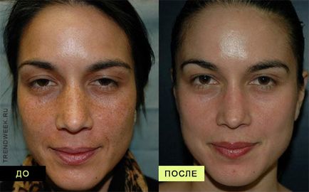 Peeling mecanic se confruntă cu clienții, prețurile, videoclipurile, fotografiile înainte și după procedură, la domiciliu