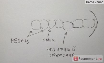 Мікроімплантація зубів в ортодонтії - «мікроіпланти - сучасна альтернатива брекетів моя історія