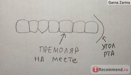 Мікроімплантація зубів в ортодонтії - «мікроіпланти - сучасна альтернатива брекетів моя історія