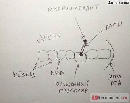 Microimplantarea dinților în ortodonție - 