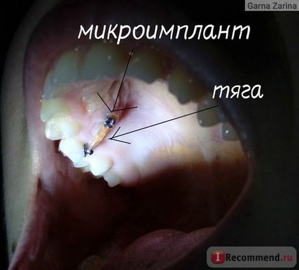 Microimplantarea dinților în ortodonție - 