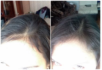 Minox lotion-spray pentru cititorii de test de creștere a părului