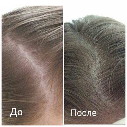 Minox lotion-spray pentru cititorii de test de creștere a părului