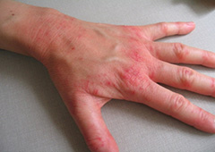 Мокнучі екзема на руках симптоми хвороби і методи лікування