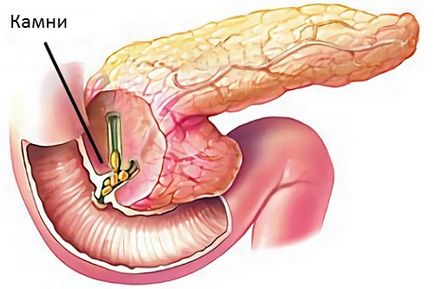 Dieta necesară pentru colelitiază și pancreatită