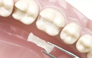 Новітні методи в лікування зубів, пломбування зубів, усунення болю в зубах
