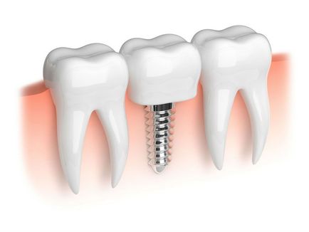 Cele mai noi metode in tratamentul dintilor, umplerea dintilor, indepartarea durerii in dinti
