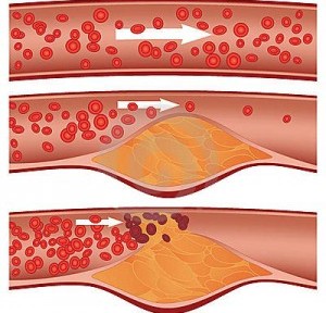 Atherosclerosis obliteraciót lábak - okai, tünetei és kezelése