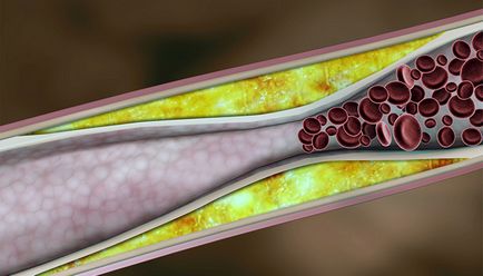 Curățăm vasele de sânge de la colesterol la domiciliu - revista pentru femei