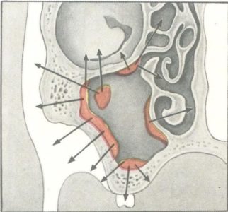 Пухлина гайморової пазухи симптоми і лікування новоутворень
