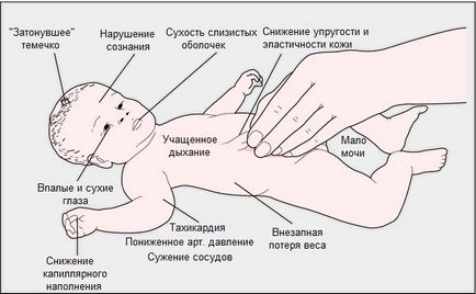 Оральна регідратація дітей ніж поїти дитину при хвороби симптоми зневоднення