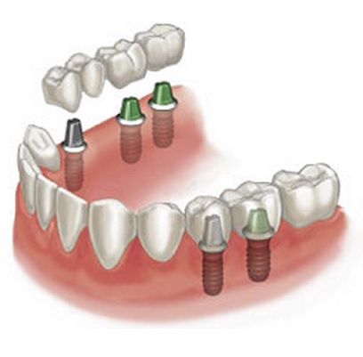 Ортопедична стоматологія, ортопедична, стоматологія
