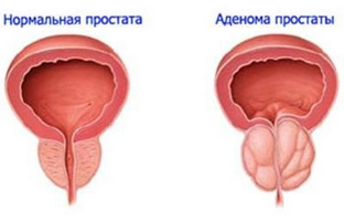 Основні методики лікування раку простати за допомогою бджолиного підмору