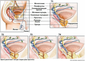 Основні методики лікування раку простати за допомогою бджолиного підмору