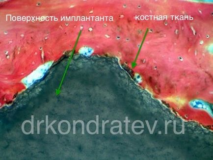 Respingerea unui implant dentar, Dr. Kondratev