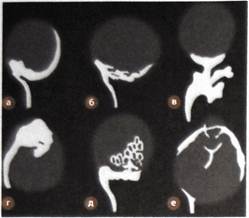 Boli parazitare ale sistemului reproducător urinar și masculin, echinococcoză renală