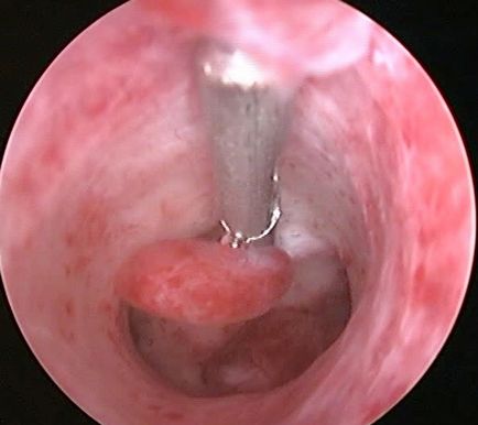 Patologia endometrului