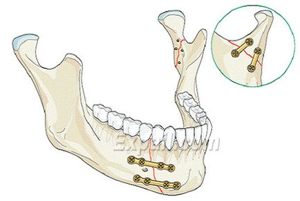 Tratamente de fractură a maxilarului în stomatologie ieftină