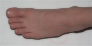 Fractura celui de-al cincilea os metatarsal al piciorului, gipsului, reabilitare, câte vindecă