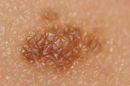 Semne de boală a melanomului pigmentar, localizări, metode de diagnostic, metode de tratament,