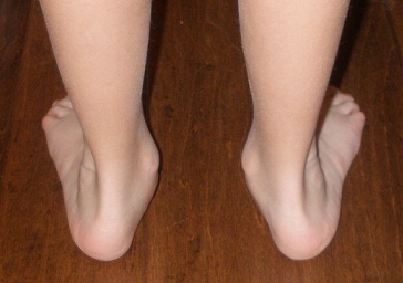 Picioarele picioarelor la copii (foto)