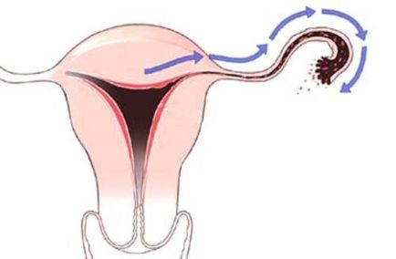 Înfrângerea adenomioză a uterului